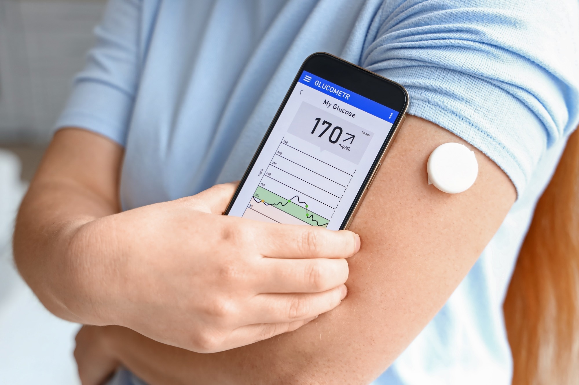 Transforming Diabetes Care with Continuous Glucose Monitoring
