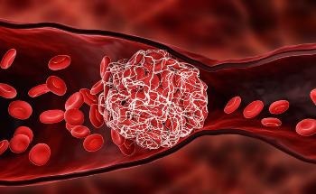 The Role of Blood Clot Sensors in Medical Treatment and Diagnostics