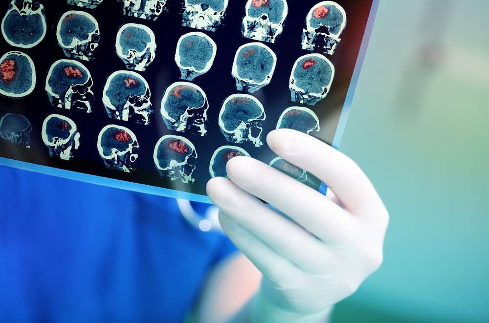 Diagnosing Brain Cancer With Just a Small Blood Sample