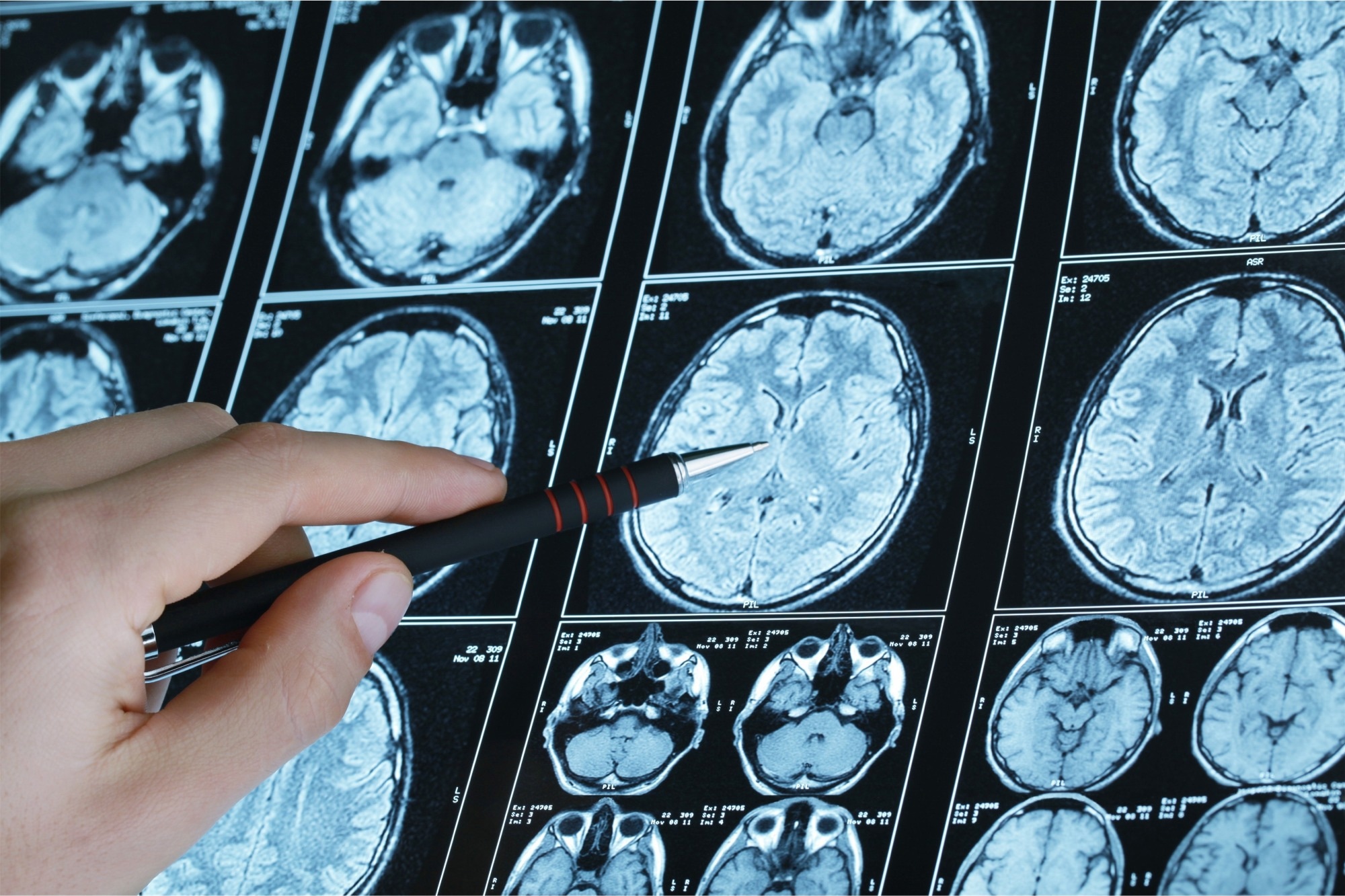 Shape-Morphing Sensor Revolutionizes Epilepsy Treatment