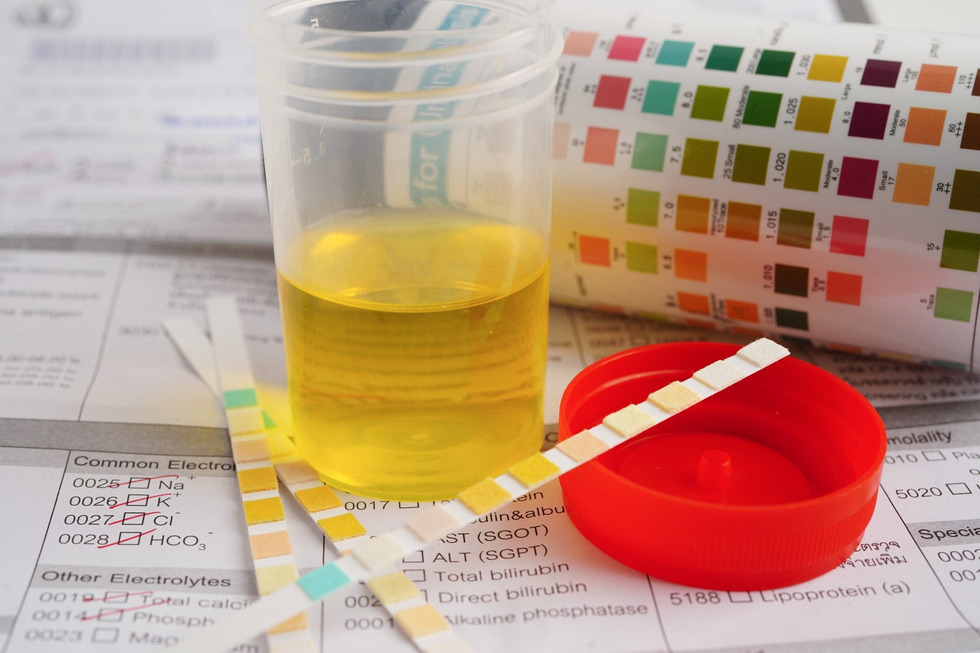 Biosensor Revolutionizes Lung Cancer Detection via Urine