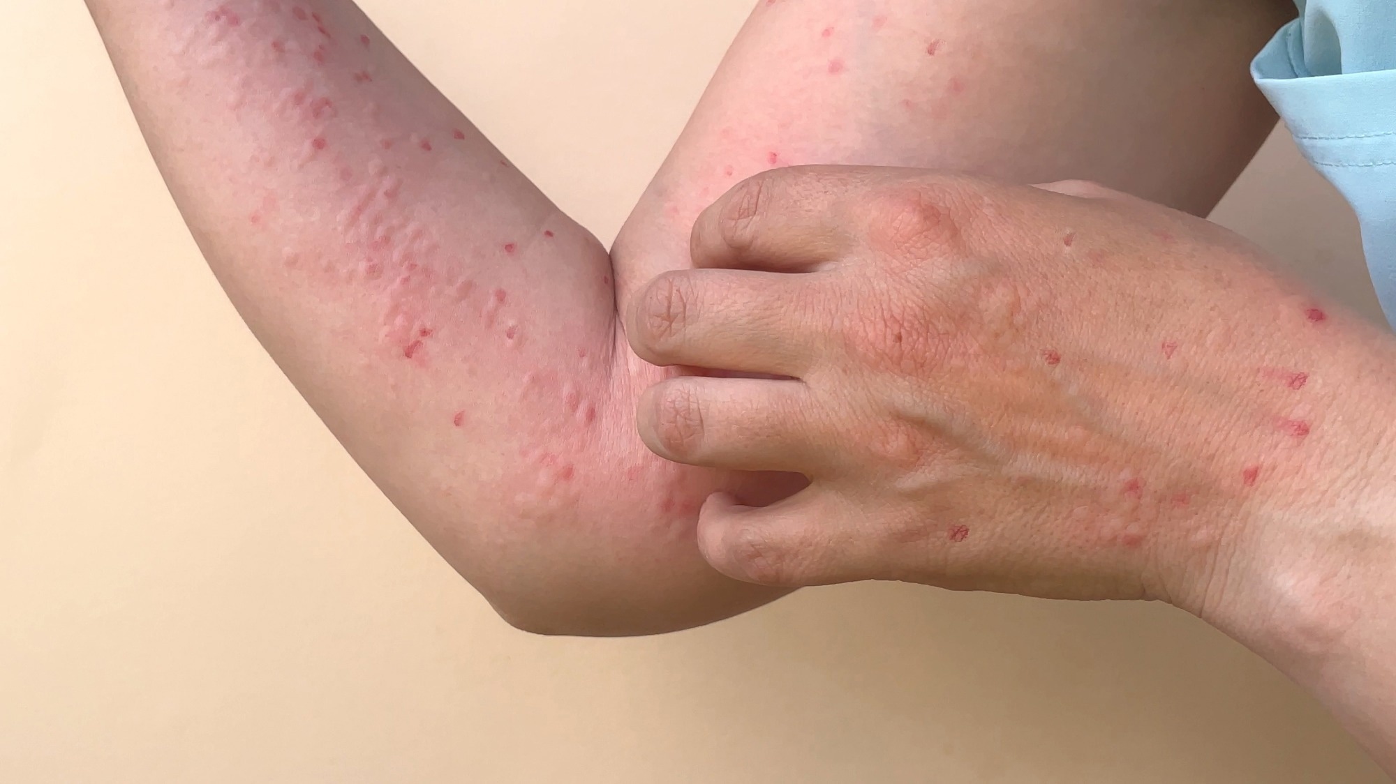 Optical Biosensor for Rapid Detection of Monkeypox Virus