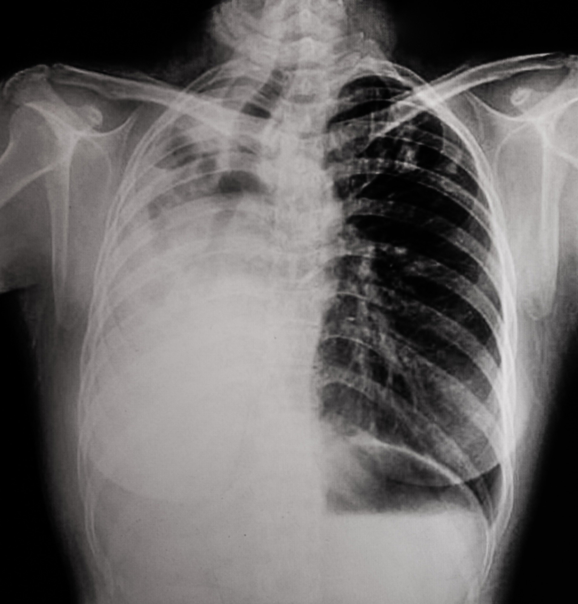Lung cancer, pleural effusion
