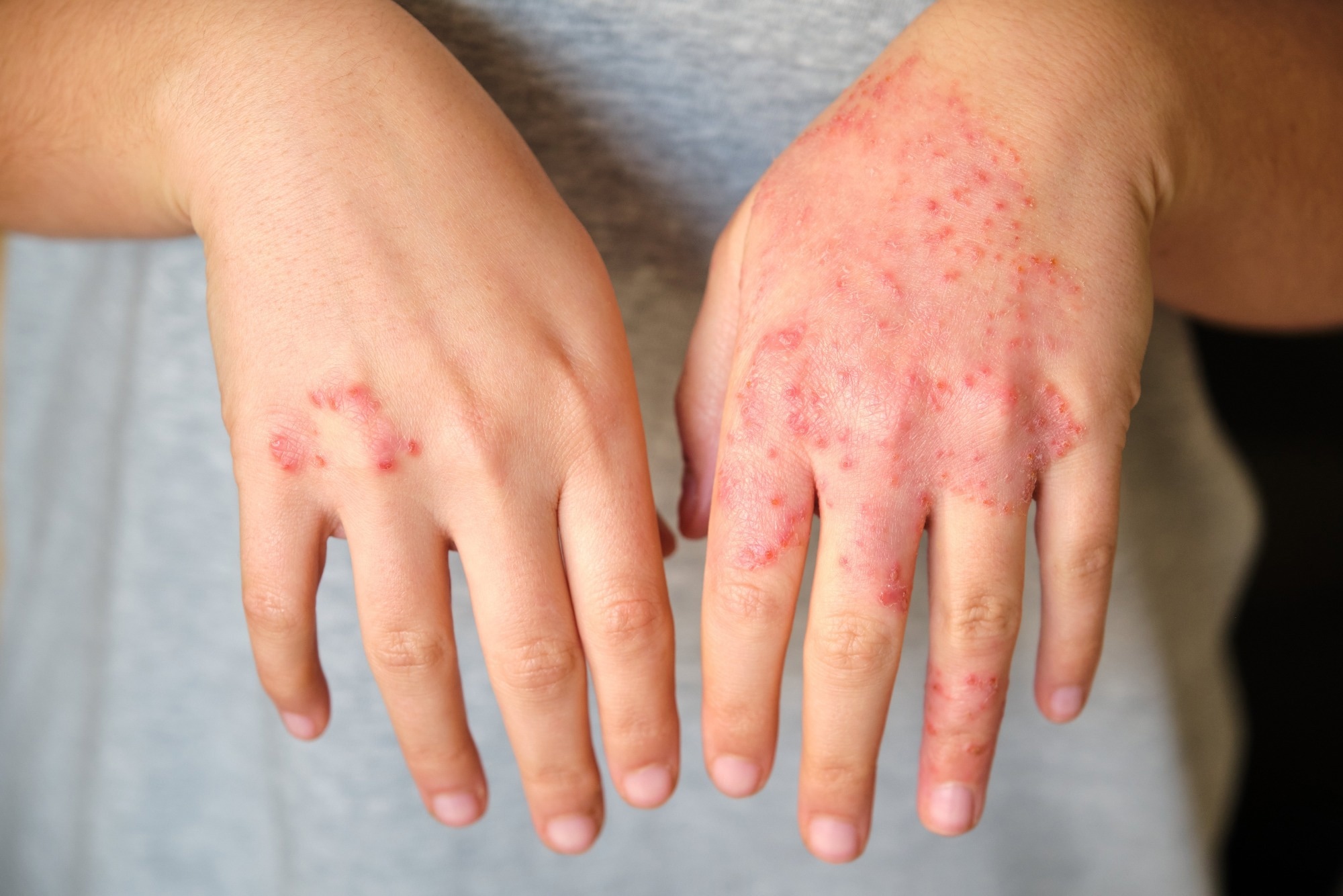 woman with eczema on hands, atopic dermatitis concept.