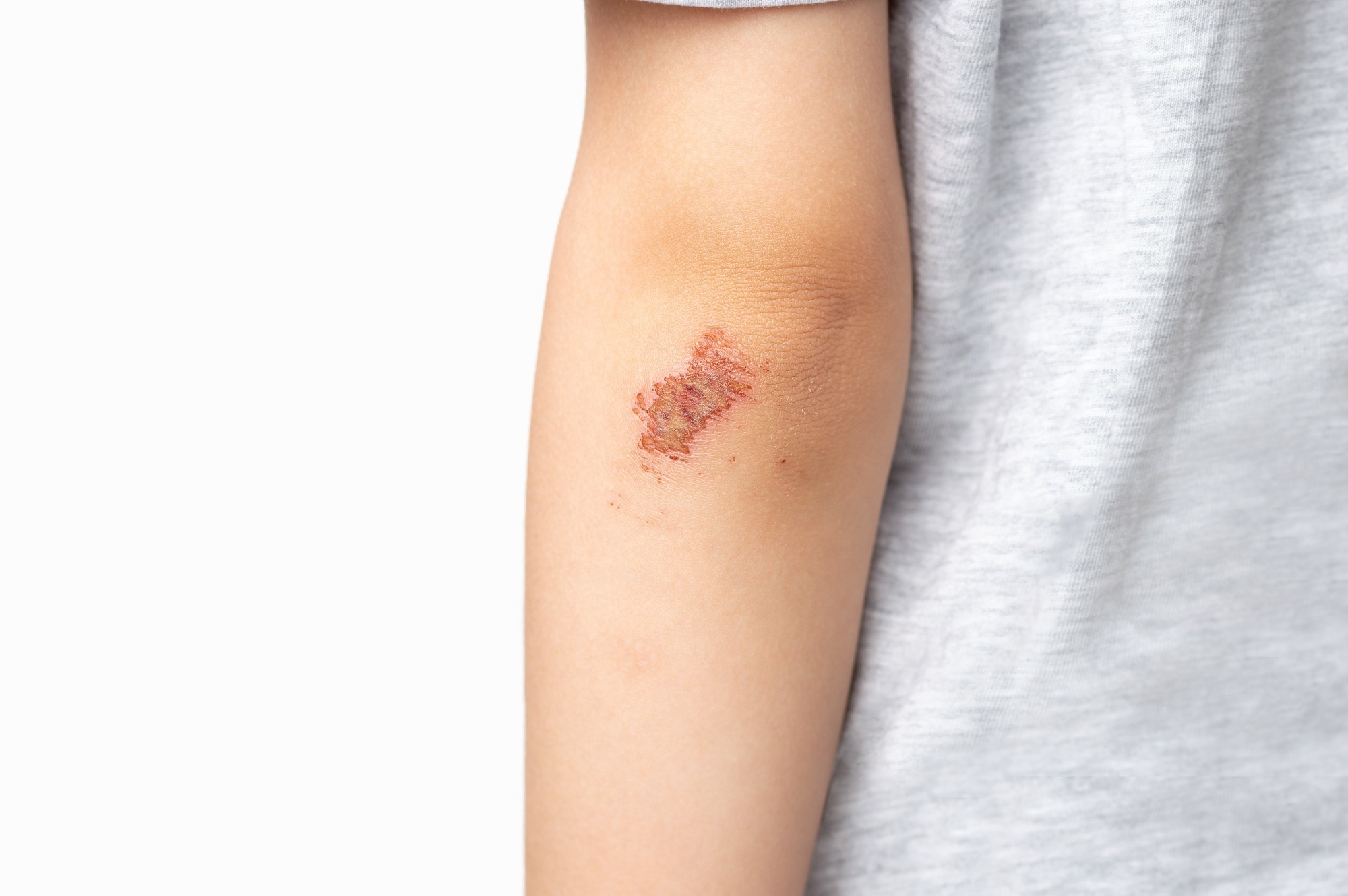 Self-Healing E-Skin Redefines Wearable Health Monitoring