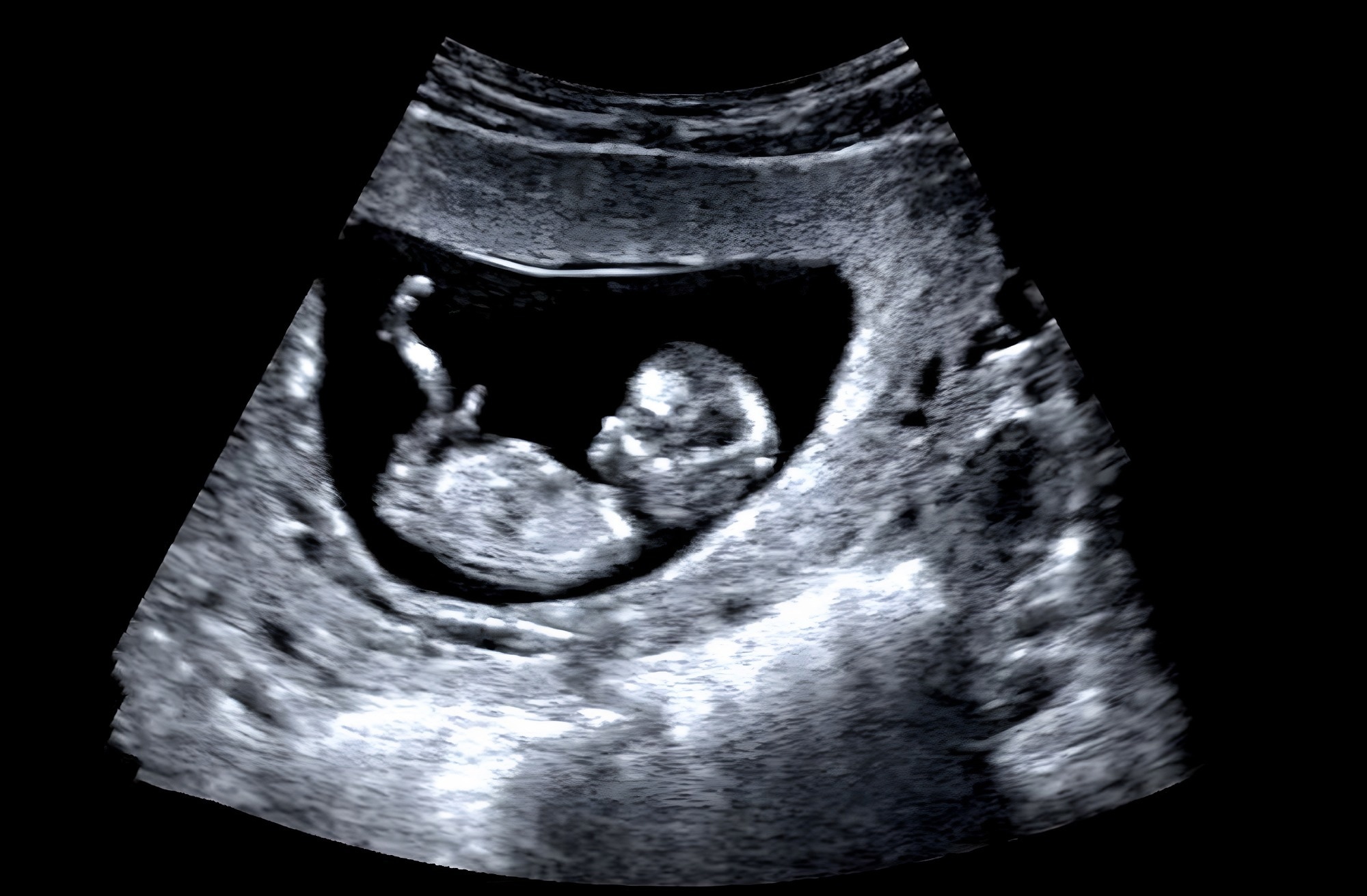 ultrasound scan of a foetus in the uterus.