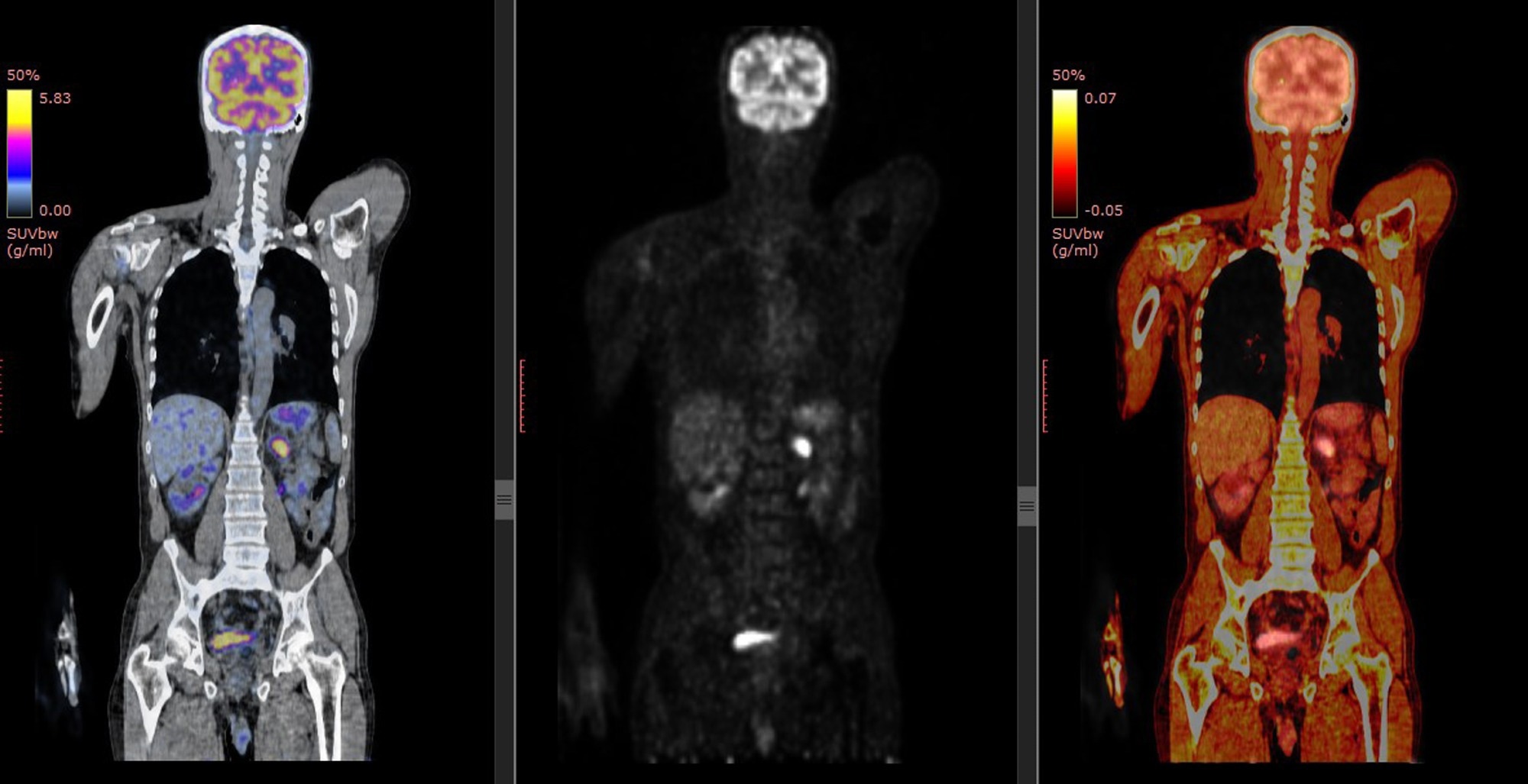 PET scan of human body.