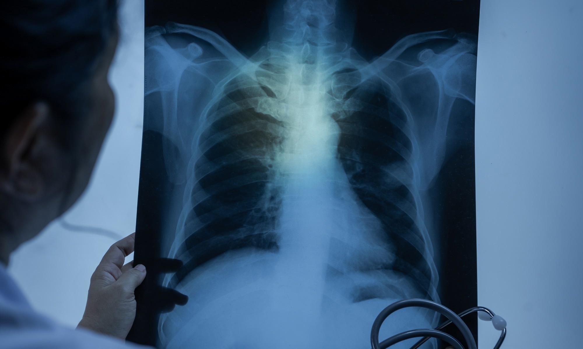 An X Ray scan of a lung with a cancerous growth.