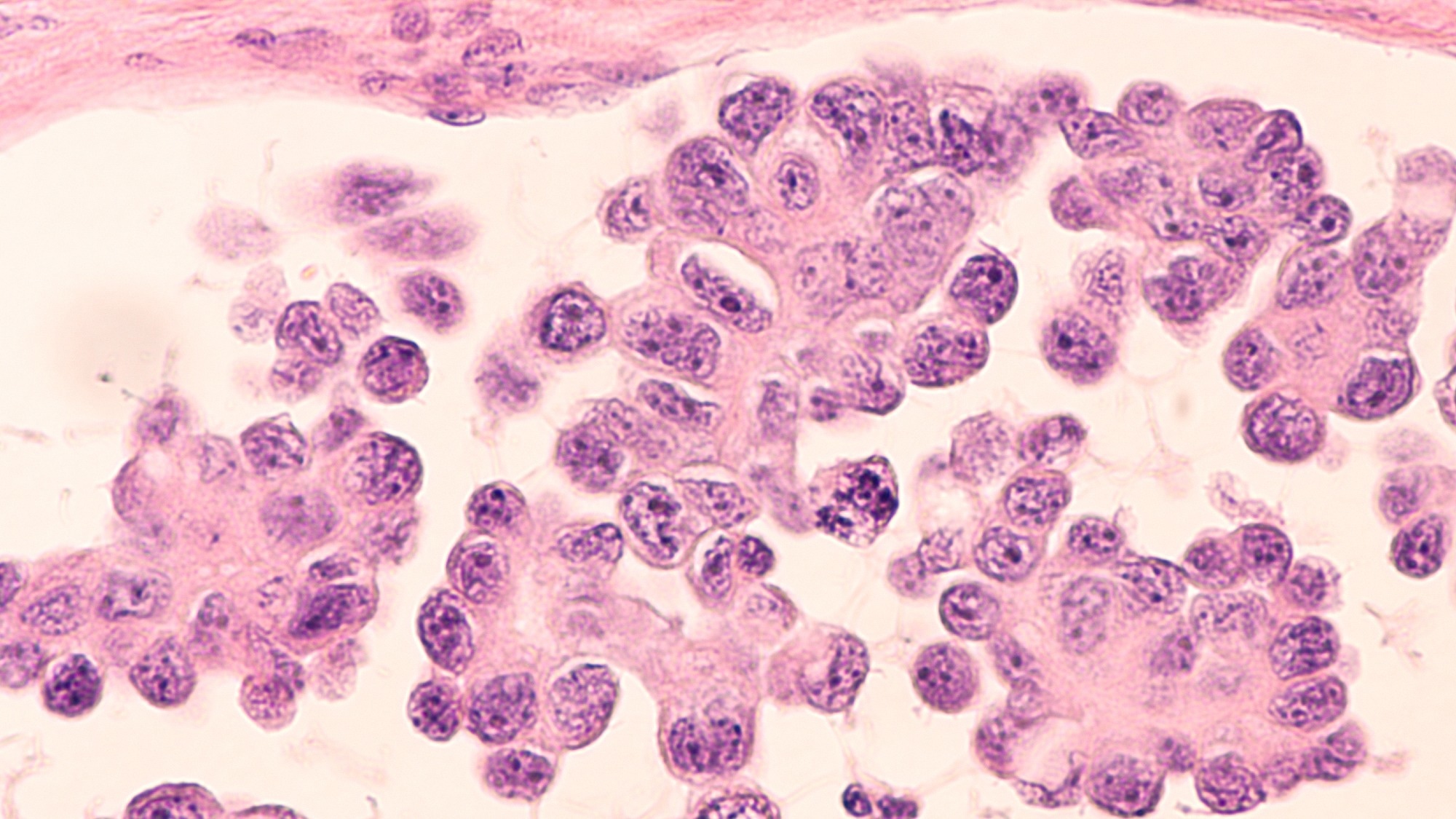 Micrograph of a serous papillary carcinoma (adenocarcinoma) of ovary, with intricately branching papillae. This tumor has a poor prognosis, as early detection is problematic.