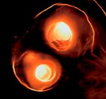Non-Invasive Ultrasound Could Help Identify Patients at Increased Risk of Future Stroke