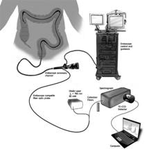 New Sensor Could Fill Major Gap in IBD Diagnosis and Treatment