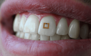 Miniaturized, Tooth-Mounted Sensors to Monitor Dietary Intake