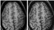 New Compressed Sensing Technique to Accelerate MRI Acquisition Process