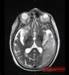 P3SENS Consortium to Develop a Biosensor System for Clinical Stroke Management