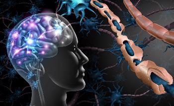 The Role of Wearable Sensors in the Early Stages of Multiple Sclerosis