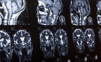 Optical Fiber Sensor Aids in Detecting Brain Injury