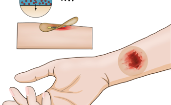 Wireless Bandage for Stimulating Chronic Wound Healing