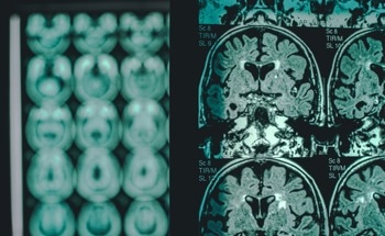 Biosensor for the Detection of Alzheimer’s Disease