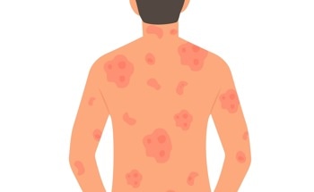 New Bioelectronic Patch Helps Treat Chronic Skin Conditions