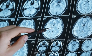 Shape-Morphing Sensor Revolutionizes Epilepsy Treatment