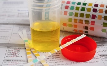 Revolutionary Biosensor Enables Early Lung Cancer Detection Through Simple Urine Test