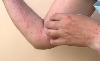 Optical Biosensor for the Rapid Detection of Monkeypox Virus