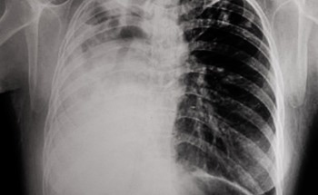 Low-Cost Sensor for Lung Cancer Biomarkers