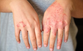 AI-Powered Wearable Device Shows Promise in Reducing Nighttime Scratching for Atopic Dermatitis Patients