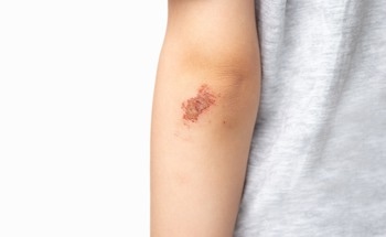 Self-Healing E-Skin Redefines Wearable Health Monitoring