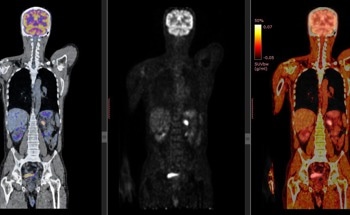 Bacteria-Specific PET Scan Detects Lung Infections With Precision