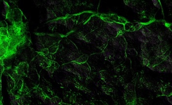 This Fluorescent Membrane Spots Pancreatic Cancer Marker with a Simple Color Change