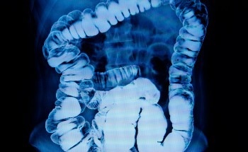 Implantable Sensor Detects Circulatory Risk after Intestinal Surgery