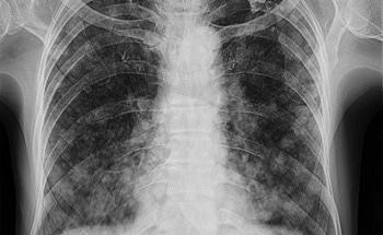 Photonic Crystal Fiber Shows Promise for Tuberculosis Screening