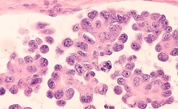 Earlier Ovarian Cancer Detection Success with eNose Sensor Tech