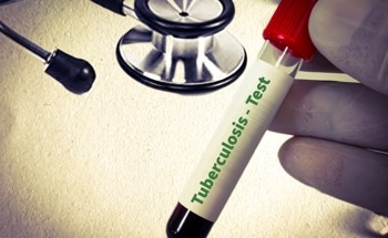 Nanoporous Sensor Enables Rapid Tuberculosis Antigen Detection